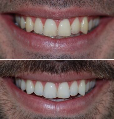 Clareamento Dental