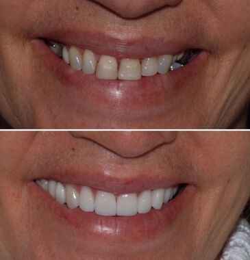 Facetas de Porcelana