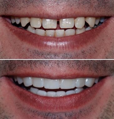 Lentes de Contato Dental