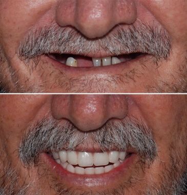 Próteses Protocolo/Dentaduras Fixas