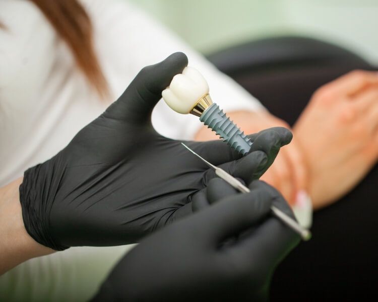 O que são os implantes dentários, quais as principais indicações e como são feitos