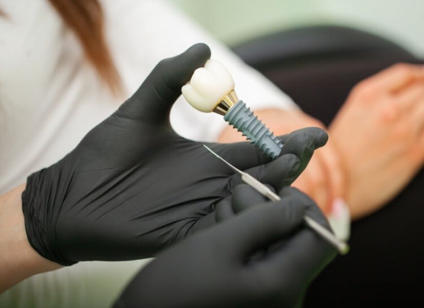 O que são os implantes dentários, quais as principais indicações e como são feitos